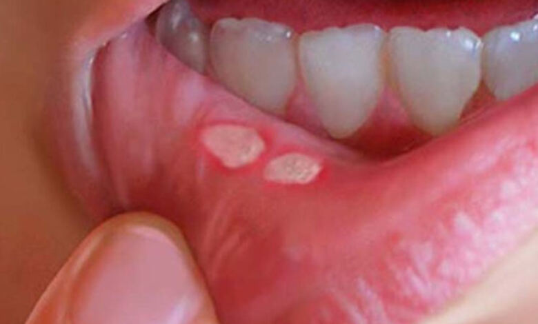 Photo of Ποιά είναι τα ύπουλα σημάδια του καρκίνου του στόματος!
