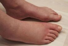 Photo of Πρήξιμο στα πόδια: ”Καμπανάκι” για σοβαρά νοσήματα – Δείτε για ποια