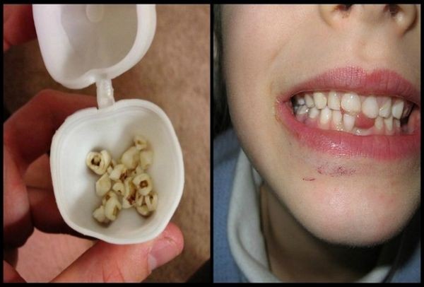 Photo of Οι γιατροί στέλνουν επείγον μήνυμα σε όλους τους γονείς να μην πετάξουν τα πρώτα δόντια των παιδιών τους