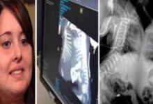 Photo of 27χρονη έγκυος πήγε να κάνει υπερηχογράφημα – Όταν το είδαν οι γιατροί πάγωσαν και της είπαν να το ρίξει (Video)