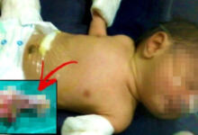 Photo of Το στομάχι του μωρού φούσκωνε και οι γιατροί αποφάσισαν να το ανοίξουν – Δεν πίστευαν τι είχε μέσα (photo)