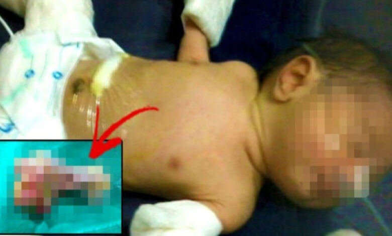 Photo of Το στομάχι του μωρού φούσκωνε και οι γιατροί αποφάσισαν να το ανοίξουν – Δεν πίστευαν τι είχε μέσα (photo)
