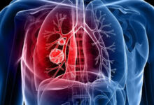 Photo of Καρκίνος του πνεύμονα: Τα σημάδια που πρέπει να σάς οδηγήσουν στον γιατρό