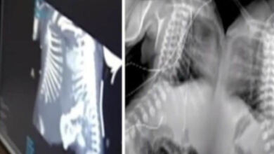 Photo of Έγκυος έκανε υπερηχογράφημα – Όταν το είδαν οι γιατροί πάγωσαν και της είπαν