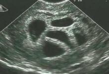 Photo of Μια έγκυος γυναίκα αγνόησε τις συμβουλές του γιατρού να κάνει έκτρωση… 20 χρόνια αργότερα δημοσιεύει αυτό!