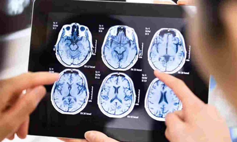 Photo of Το νο.1 σύμπτωμα όγκου στον εγκέφαλο για το οποίο οι περισσότεροι απλά δεν δίνουν σημασία