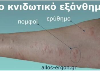 Γιατί εμφανίζονται πομφοί στο δέρμα; Αυτοί είναι οι απρόσμενοι παράγοντες που ίσως δεν γνωρίζετε