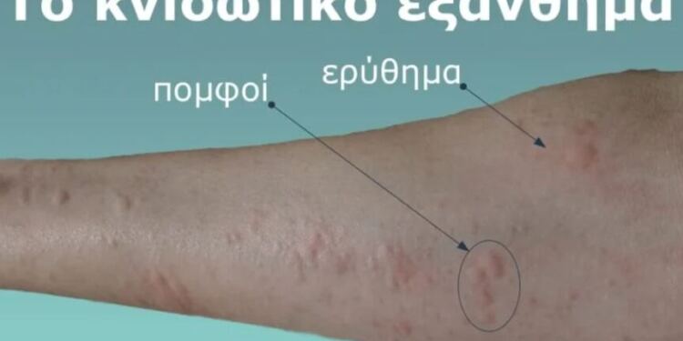 Γιατί εμφανίζονται πομφοί στο δέρμα; Αυτοί είναι οι απρόσμενοι παράγοντες που ίσως δεν γνωρίζετε