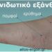 Γιατί εμφανίζονται πομφοί στο δέρμα; Αυτοί είναι οι απρόσμενοι παράγοντες που ίσως δεν γνωρίζετε