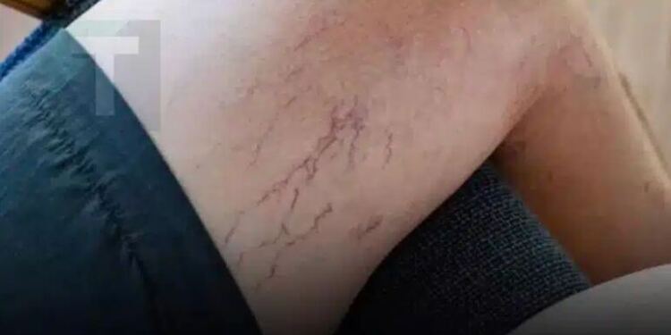 Φλέβες στα πόδια που γίνονται μωβ; Nα τι πρέπει να γνωρίζετε