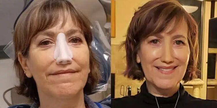 «Έπρεπε να αφαιρέσω τη μύτη μου ή να παλέψω με τον θάνατο, σήμερα όμως αıσθάνομαı τυχερń»