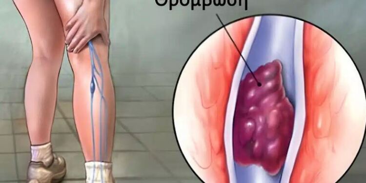 7 τρόποι για να προλάβετε τη θρόμβωση