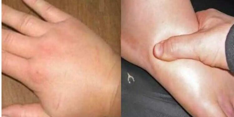 Απαλλαγείτε γρήγορα από τα πρησμένα χέρια και πόδια: Σπιτικές θεραπείες για την κατακράτηση υγρών